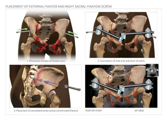Placement of External Fixator and Right Sacral Fixation Screw