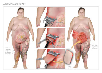 Abdominal Skin Graft