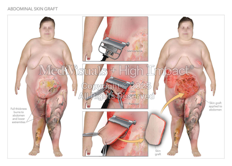 Abdominal Skin Graft