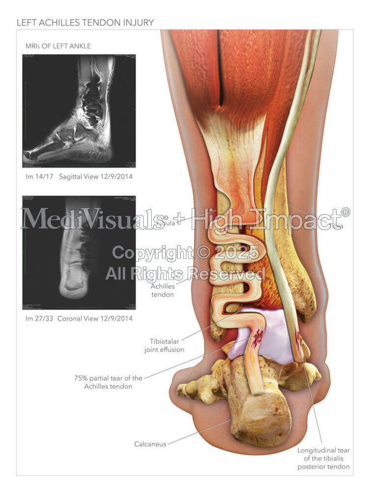 Achilles Tendon Injury