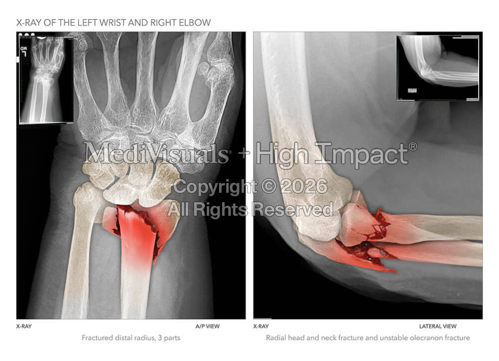 X-Ray of the Left Wrist and Right Elbow