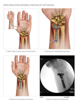 Open Reduction Internal Fixation of Left Radius