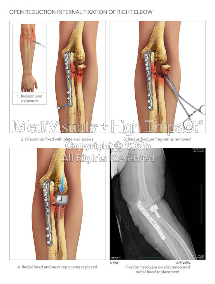 Open Reduction Internal Fixation of Right Elbow