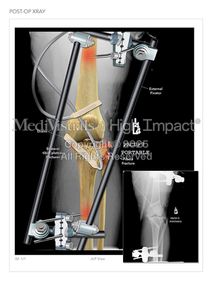 Post-Op X-Ray
