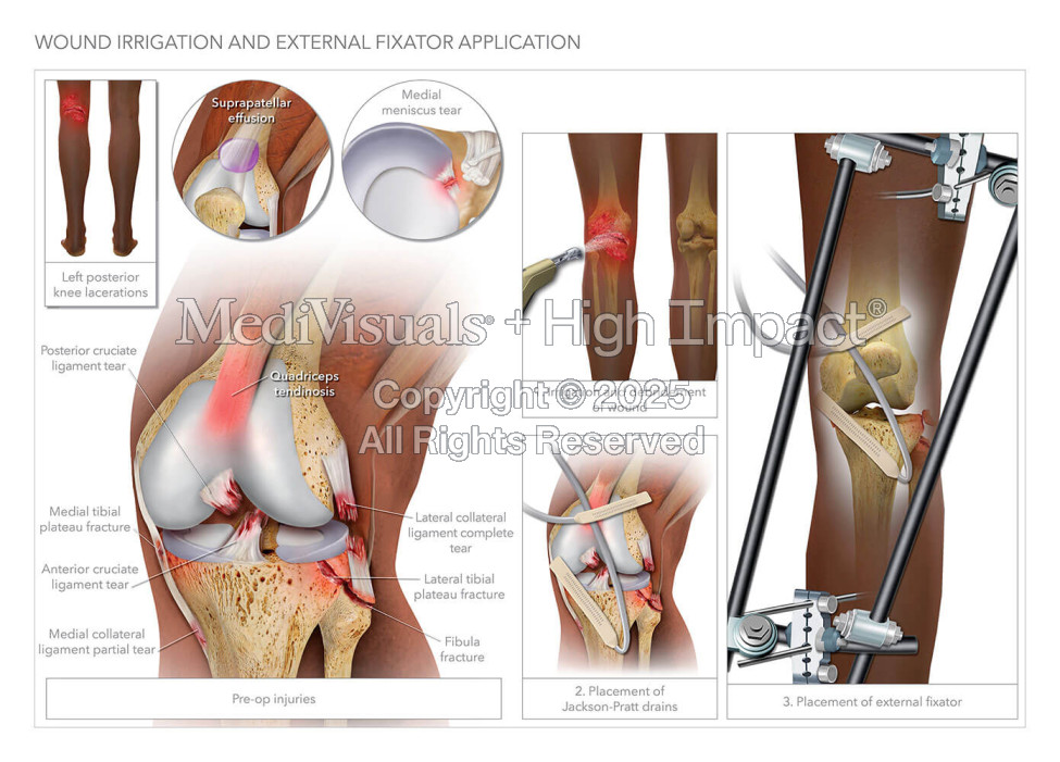 Wound Irrigation and External Fixator Application