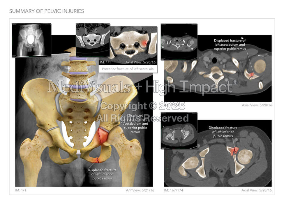 Pelvic Injury Summary