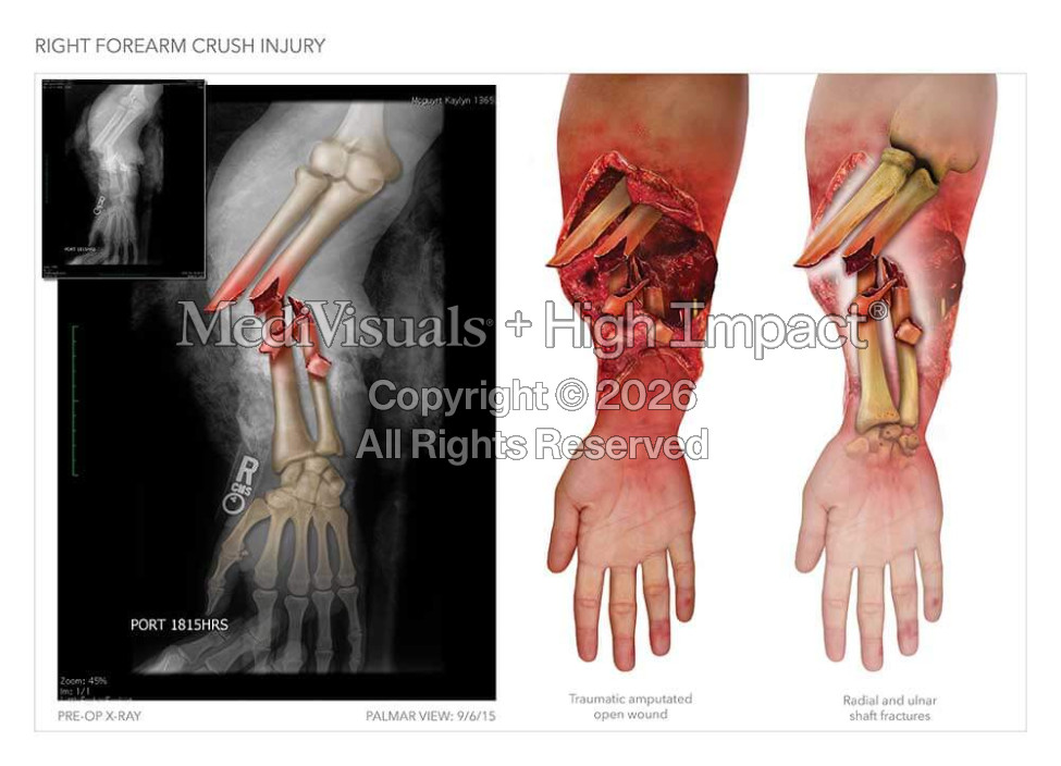 Forearm Crush Injury and Amputation