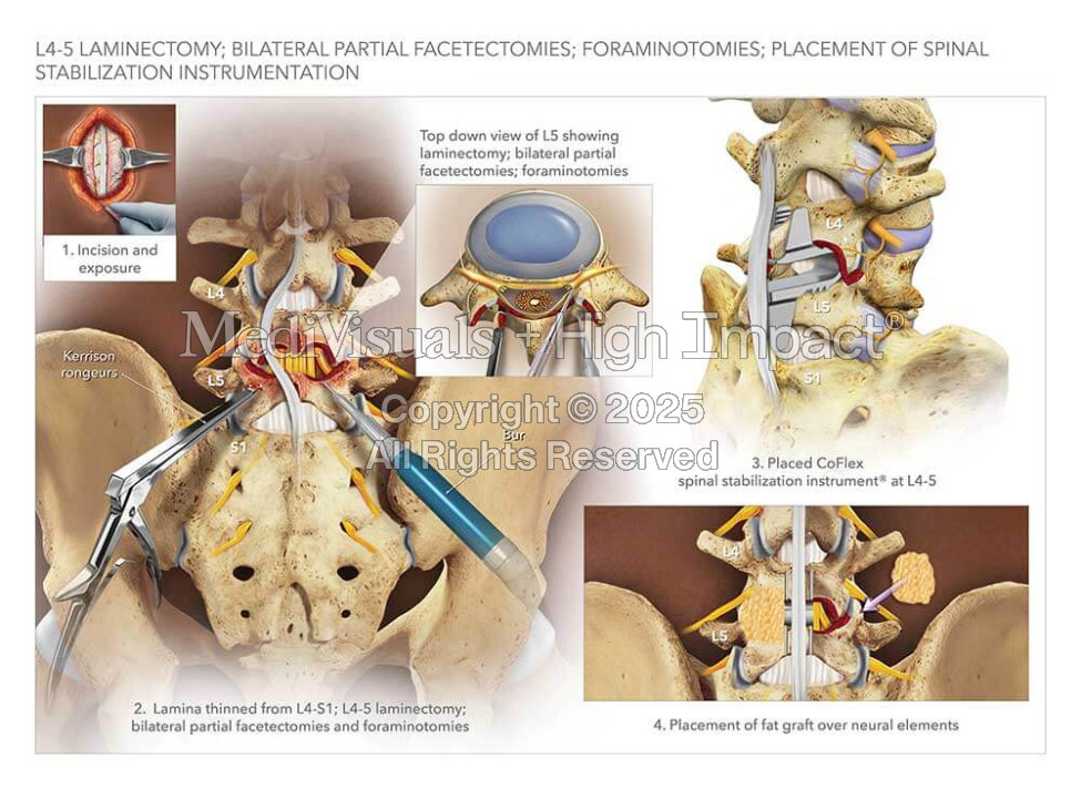 L4-5 Decompression and Stabilization