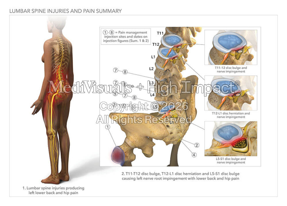 Lumbar Spine Injuries and Pain Summary