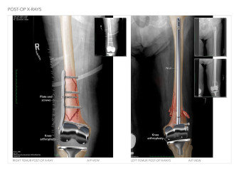Post-Op X-Rays