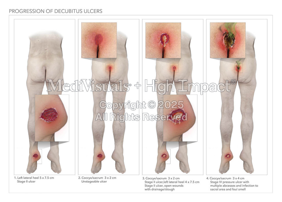 Progression of Decubitus Ulcers
