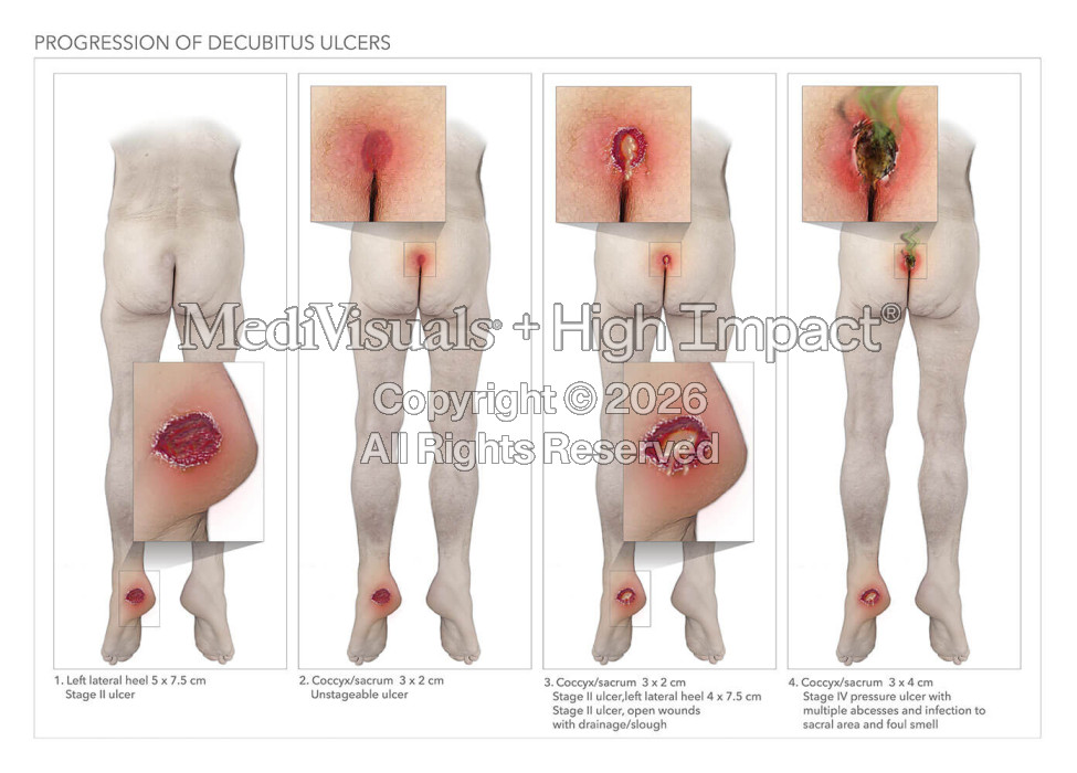 Progression of Decubitus Ulcers