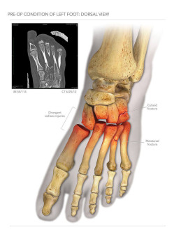 Operation of Left Foot