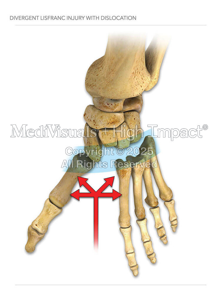 Divergent Lisfranc Injury with Dislocation