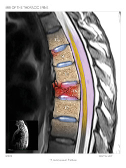 MRI of the Thoracic Spine