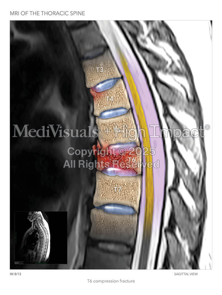 MRI of the Thoracic Spine