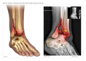 Trimalleolar Fracture and Repair