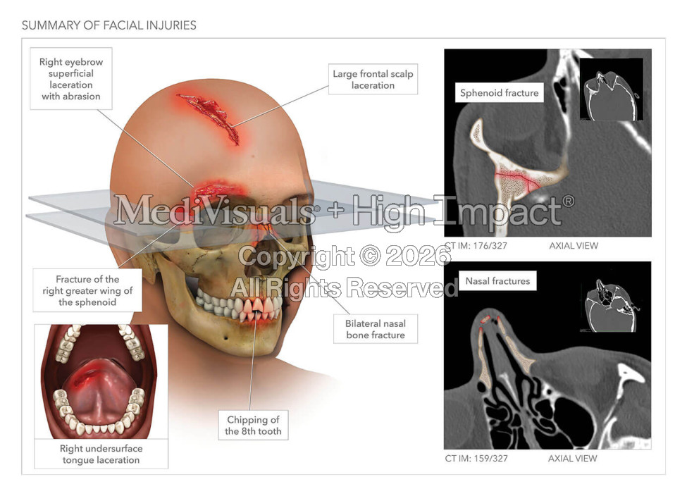 Summary of Facial Injuries