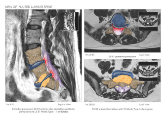 MRIs of Injured Lumbar Spine