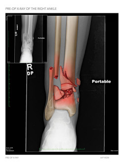 Pre-Op X-Ray of the Right Ankle