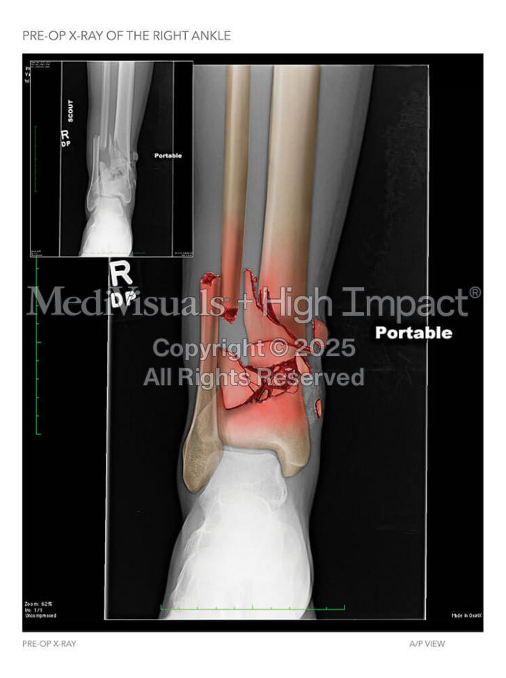 Pre-Op X-Ray of the Right Ankle