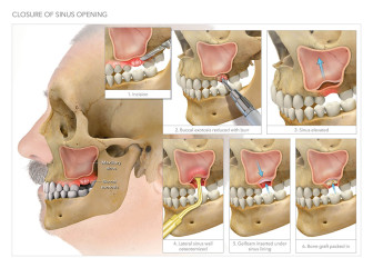 Closure of Sinus Opening
