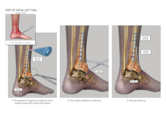 ORIF of Distal Left Tibia