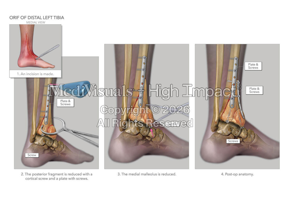 ORIF of Distal Left Tibia