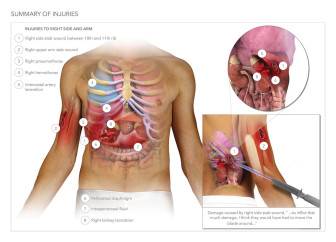Stab Wounds and Repair