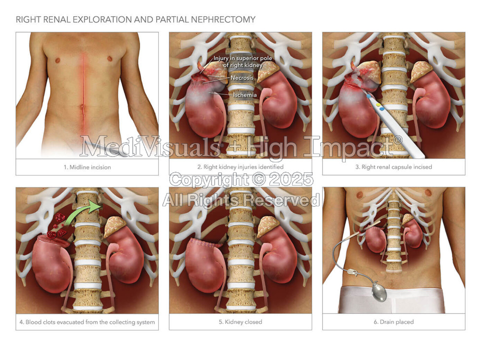 Right Renal Exploration and Partial Nephrectomy