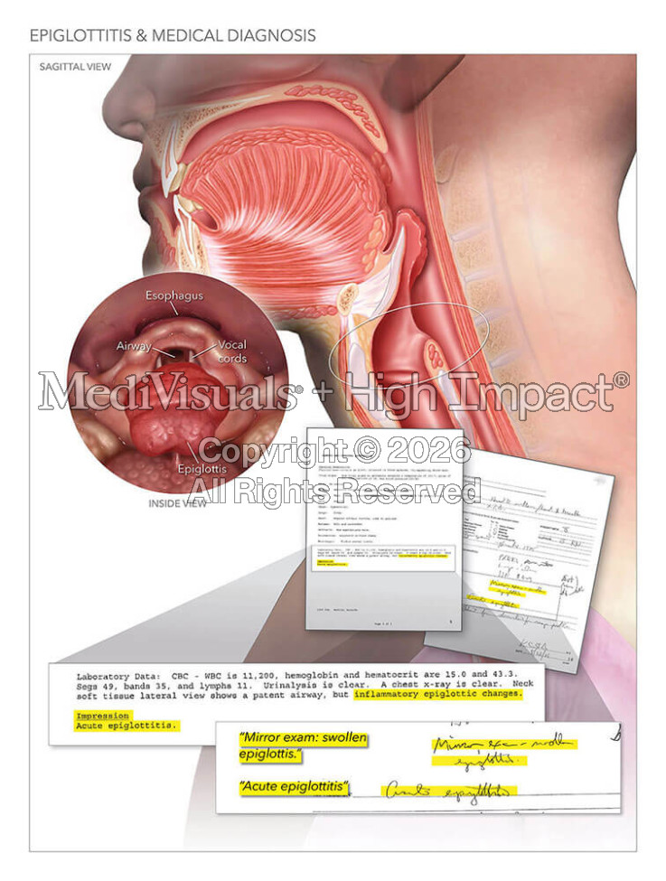 Epiglottitis & Medical Diagnosis