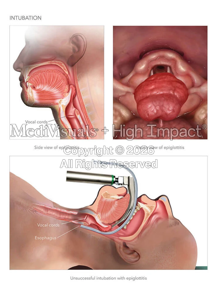 Intubation