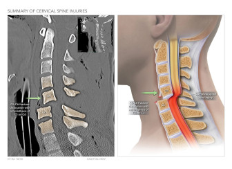 Summary of Cervical Spine Injuries