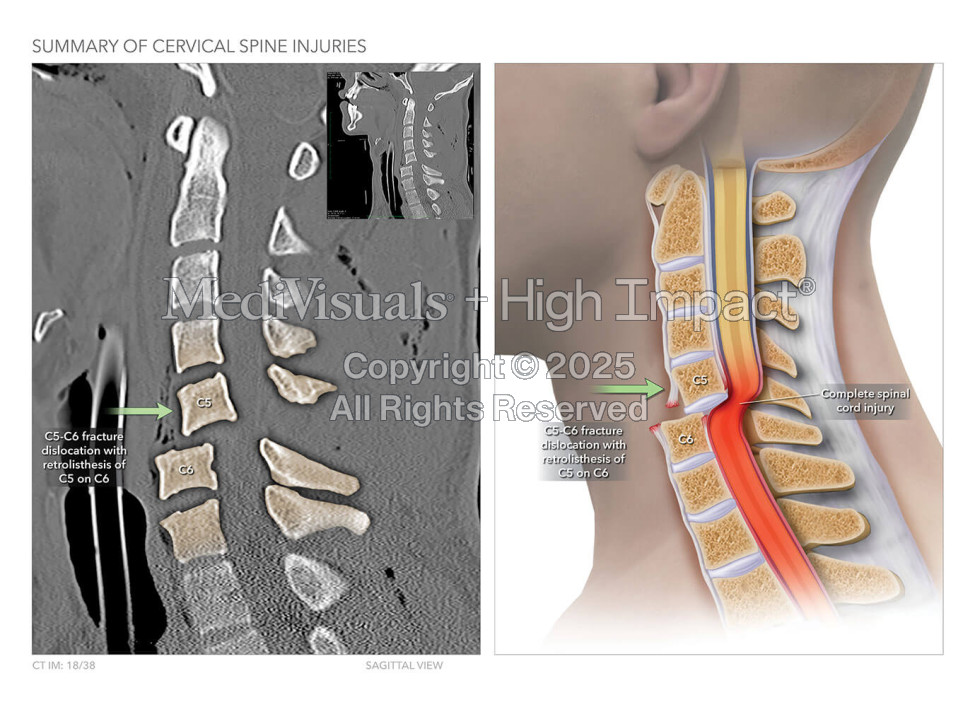 Summary of Cervical Spine Injuries
