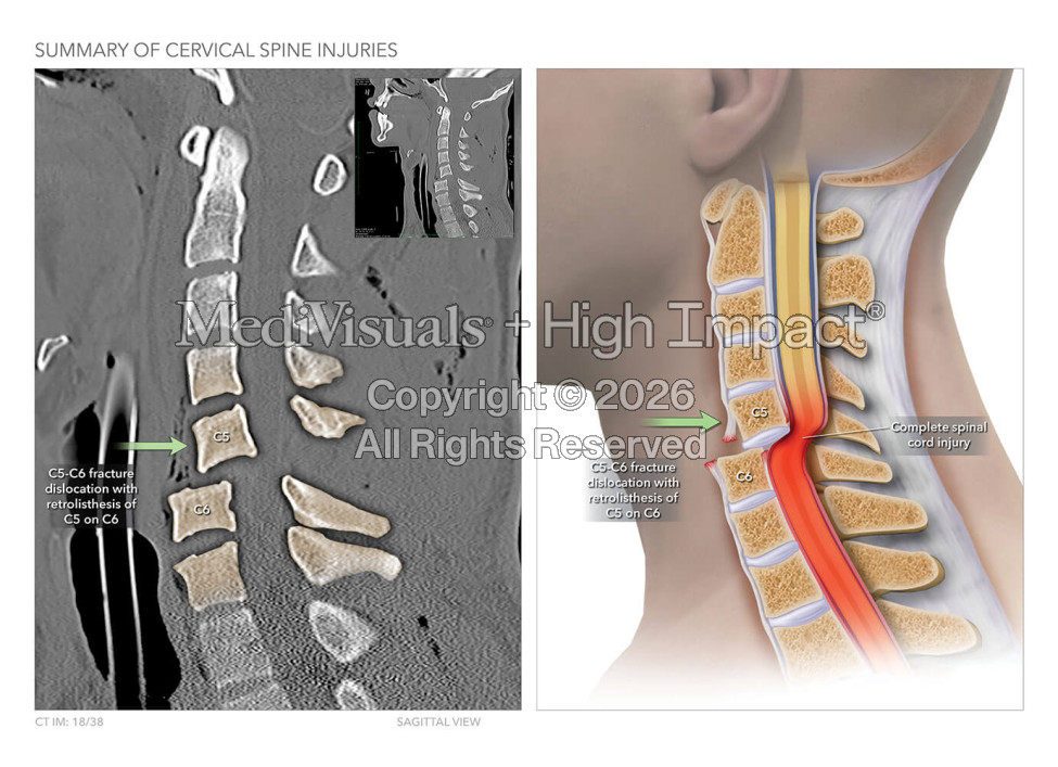 Summary of Cervical Spine Injuries