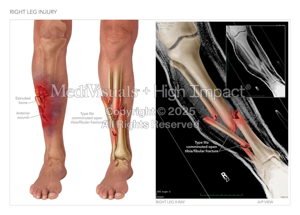 Leg Small Injury Right Leg Injury