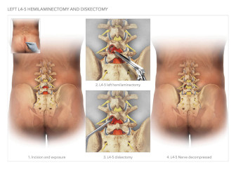 Hemilaminectomy and Diskectomy