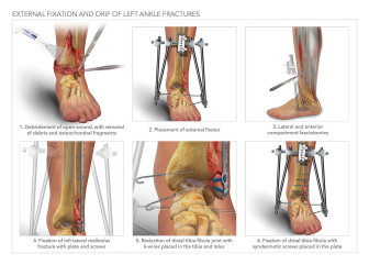 External Fixation and ORIF of Left Ankle Fractures