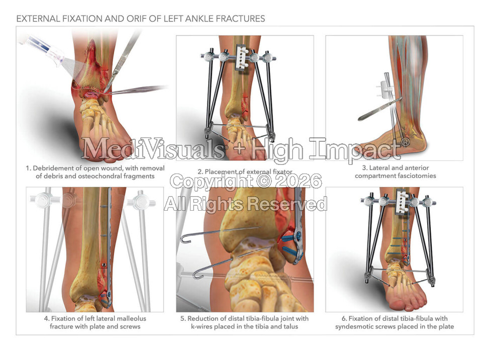 External Fixation and ORIF of Left Ankle Fractures