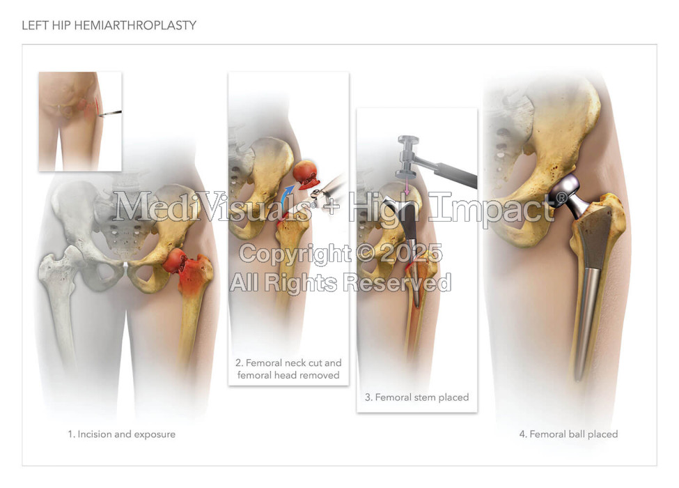 Left Hip Hemiarthroplasty