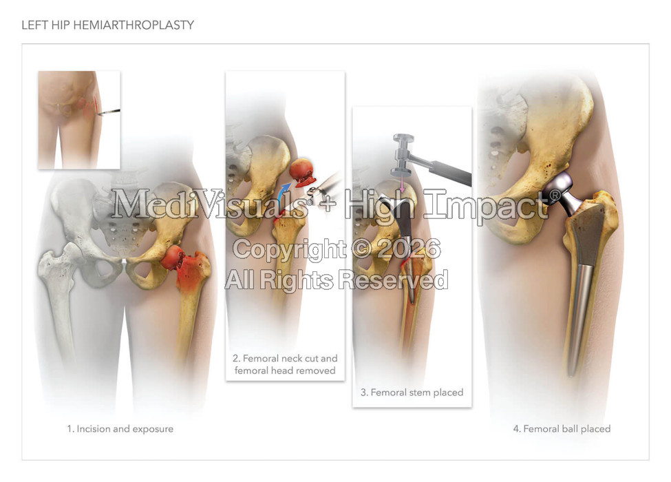 Left Hip Hemiarthroplasty