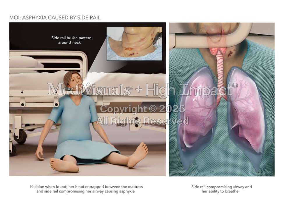 Asphyxia Caused by Side Rail