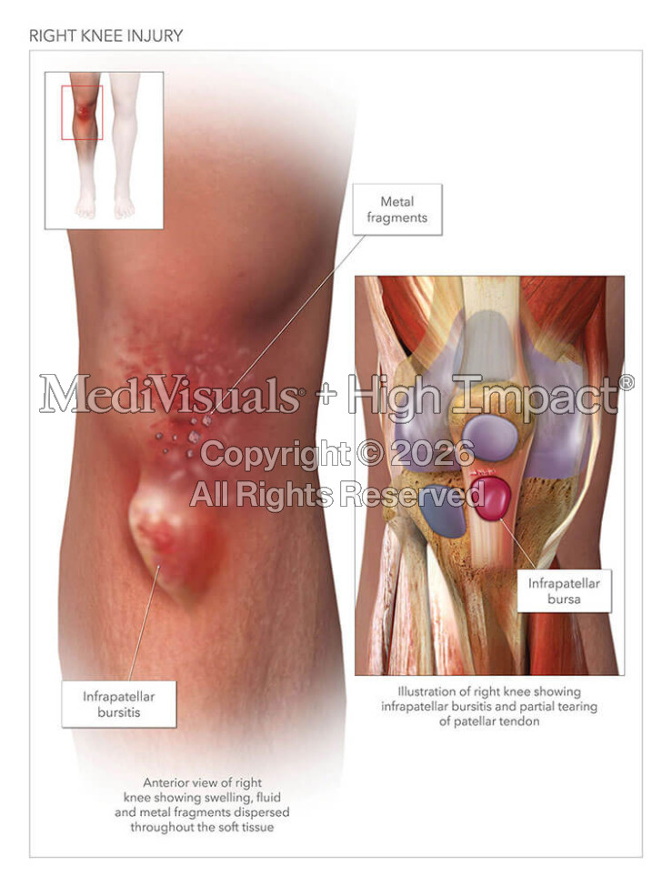 Right Knee Injury