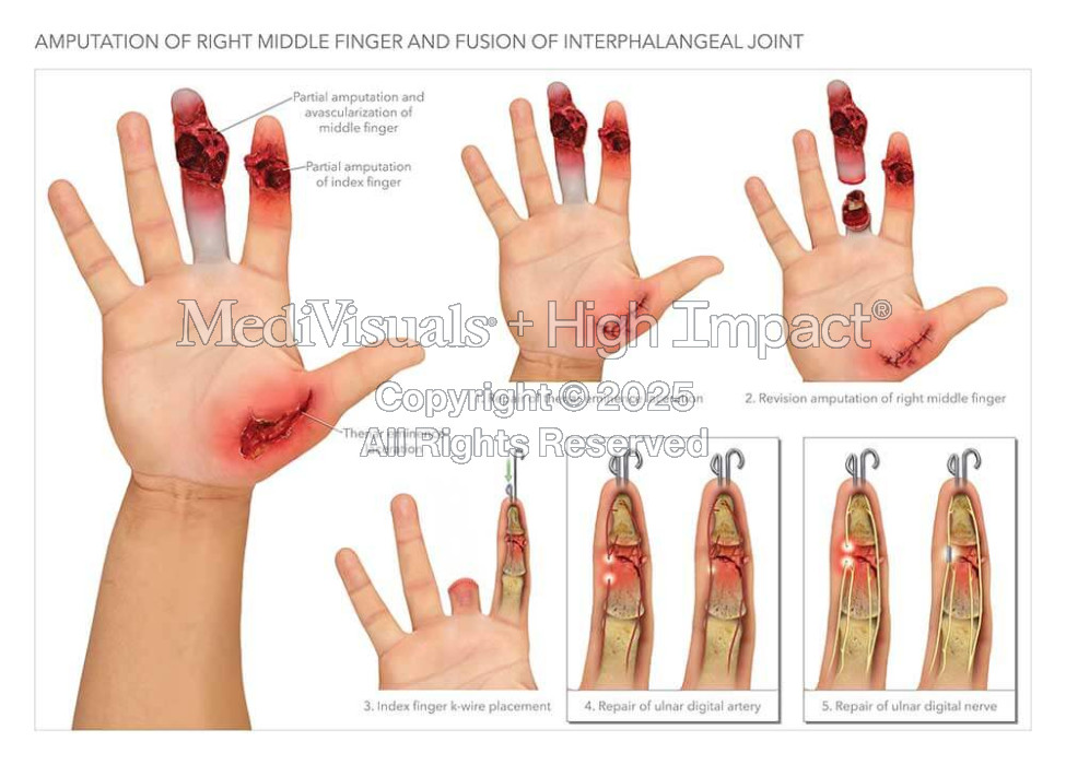 Summary of Hand Injuries and Procedures