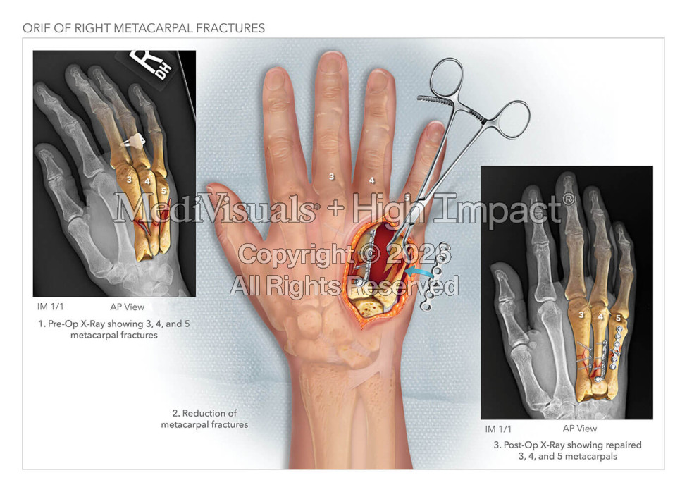 ORIF of Right Metacarpal Fractures