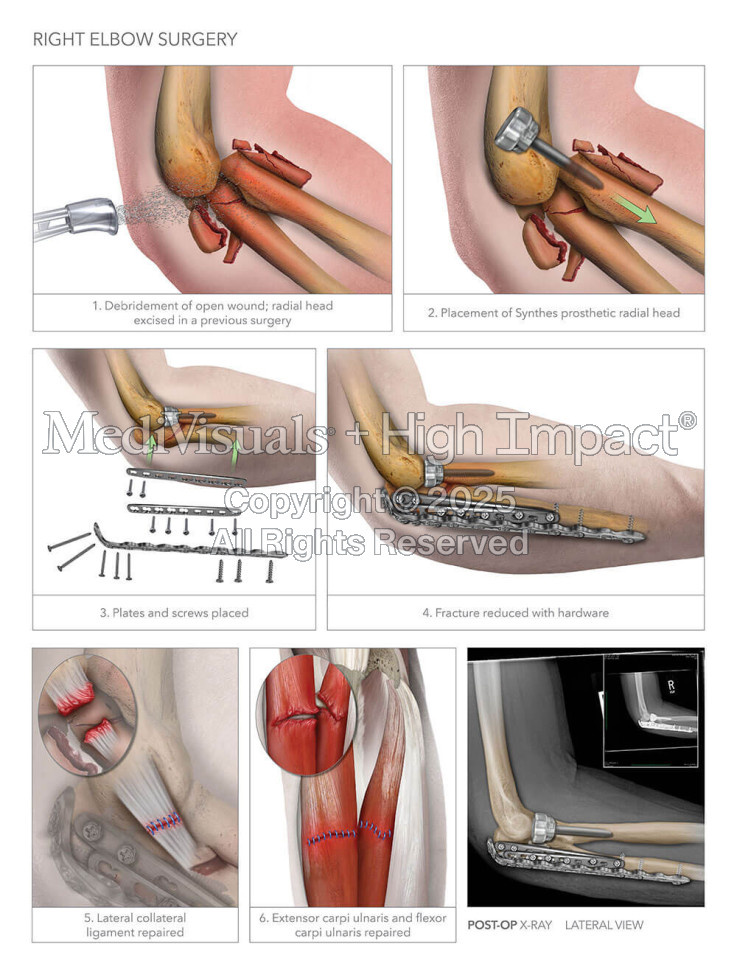 Right Elbow Surgery