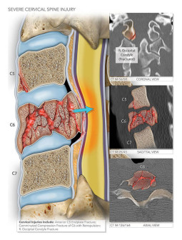 Cervical Spine Injury