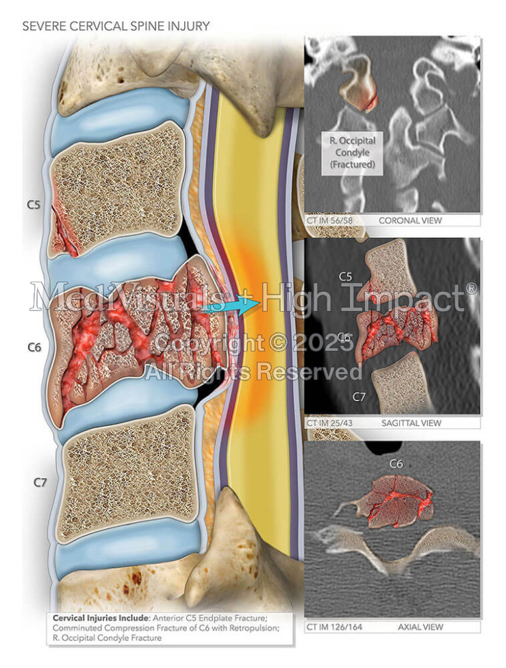 Cervical Spine Injury
