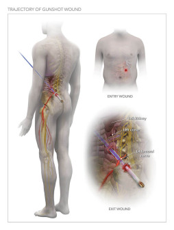 Trajectory of Gunshot Wound