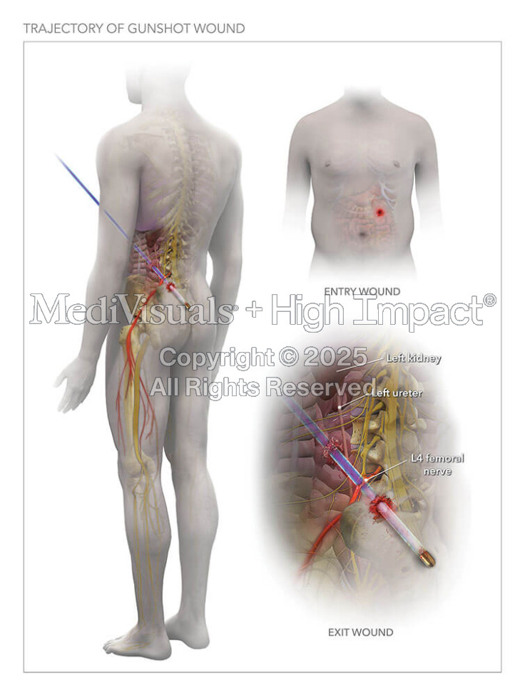Trajectory of Gunshot Wound